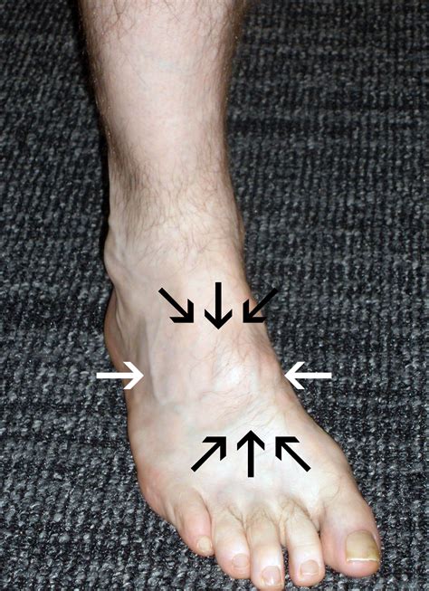 Lisfranc Injury Footeducation