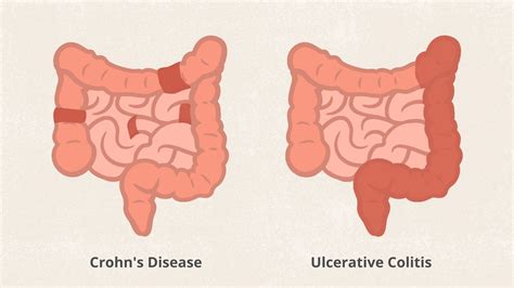 What Is Crohns Disease Symptoms Causes Diagnosis Treatment And