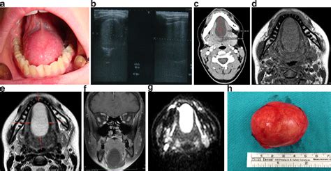Figure 1 From Imaging Features Of Sublingual Dermoid Cysts A Report Of