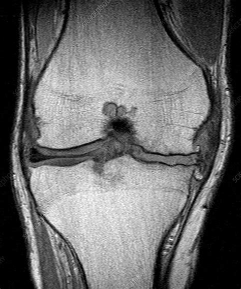 Knee Arthritis Mri Stock Image C0271219 Science Photo Library