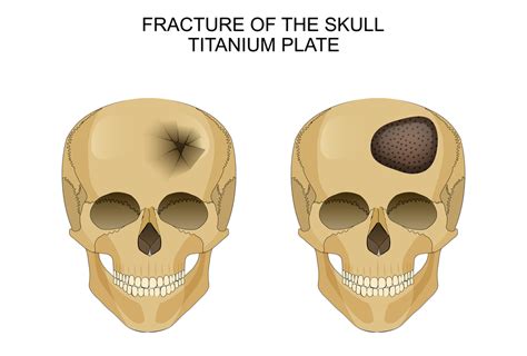Skull Fractures Types Symptoms Causes And Treatment Zealmax