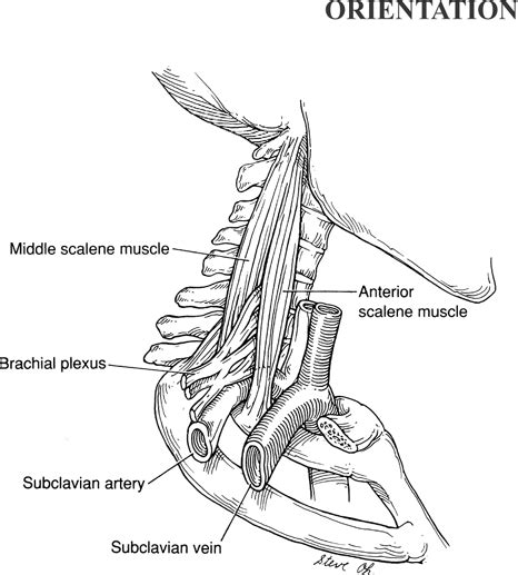 First Rib Resection For Thoracic Outlet Syndrome Basicmedical Key