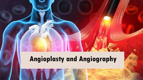 What Is The Difference Between Angioplasty And Angiography Sushmita Sen