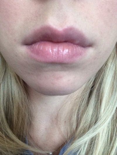 Is This Lump On Lip From Filler Or Swelling After Restylane Photo
