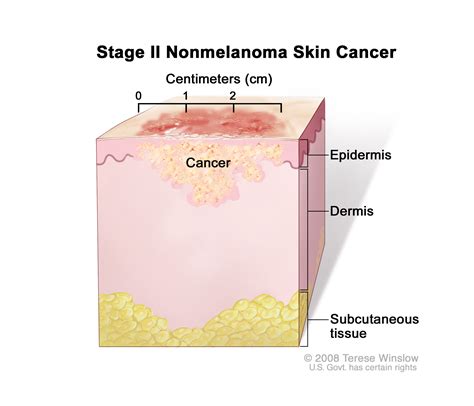 Skin Cancer Treatment Pdq® Patients Siteman Cancer Center