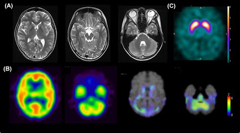 Neuroimaging Evaluation And Successful Treatment By Using Directional