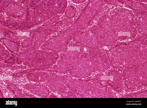 Salivary Gland Tumour Light Micrograph Of A Section Through An Adenoma