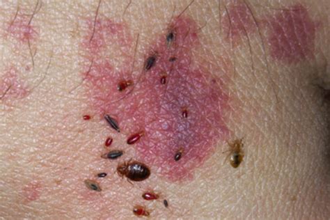 What Do Bed Bug Bites Look Like On Skin