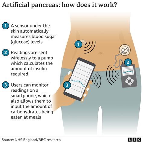Diabetes Artificial Pancreas Tech Recommended For Thousands On Nhs