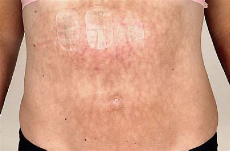 Figure 1 From A Different Cause Of Erythema Ab Igne In Chronic
