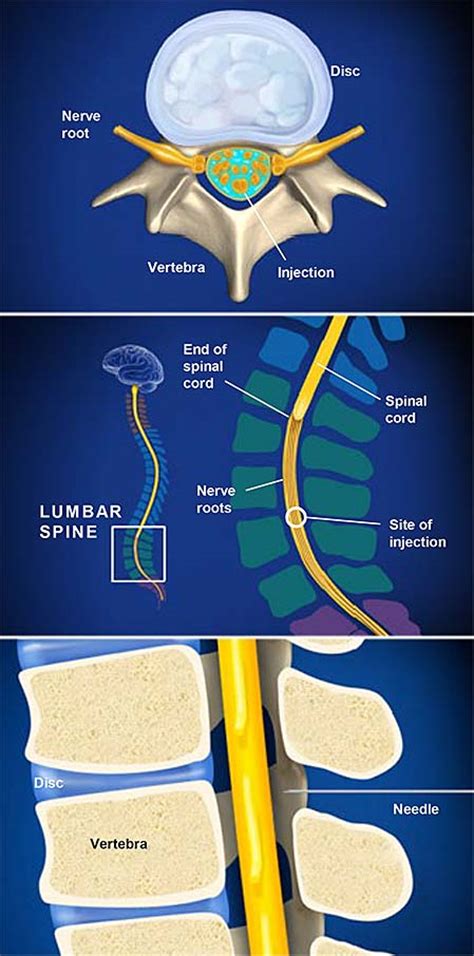 Anesthesia Lumbar Puncture Spinal Anesthesia Central Coast