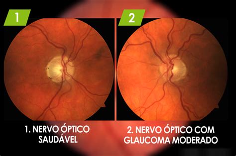 Glaucoma Hov