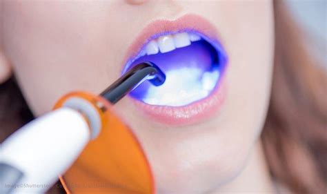 Fungsi Dan Penggunaan Dental Curing Light Dalam Kedokteran Gigi