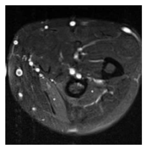 Axial T1 A And T2 B Fat Saturated Images From Patient 2 In A