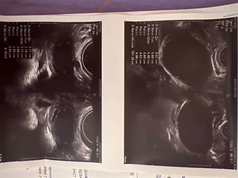 Диета киста яичника Какая киста на снимке? - Вопрос гинекологу - 03 Онлайн Какая киста на снимке? - Вопрос гинекологу - 03 Онлайн Диета киста яичника