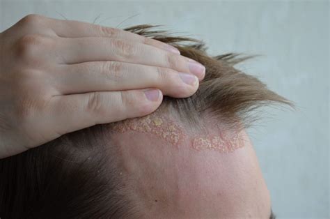 Seborrheic Dermatitis Yellow Scabs On Scalp Javsystema