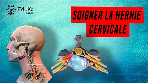 SOIGNER LA HERNIE DISCALE CERVICALE Explications Et Exercices Clipzui Com