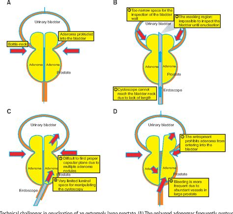 Figure From Efficacy And Safety Of Holmium Laser Enucleation Of The Prostate For Extremely