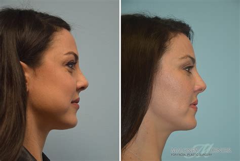 Before And After Buccal Fat Pad Removal Gallery Atlanta