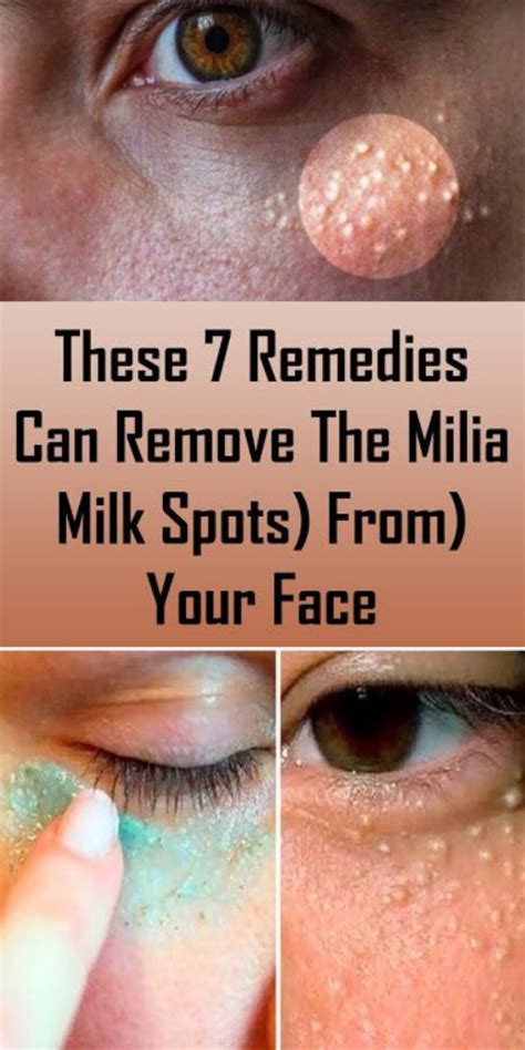 These 7 Remedies Can Remove The Milia Milk Spots From Your Face In