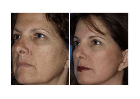 Laser Skin Resurfacing San Diego Skin Resurfacing San Diego