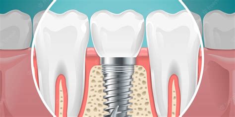 When Can I Sue For A Failed Implant Royal Dental Clinics Blog