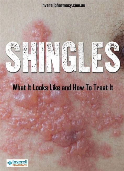 Shingles What It Looks Like And How To Treat It Artofit
