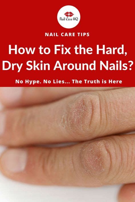 What Causes Hard Dry Skin Around Fingernails And What Can You Do About