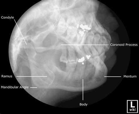 Radiographic Anatomy Mandible Oblique Facial Bones Medical