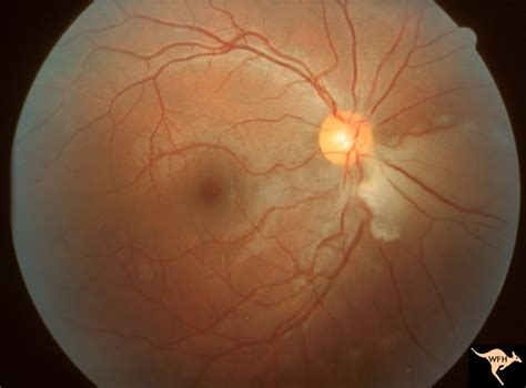 Cerebroretinal Microangiopathy Susac Syndrome Eccles Health