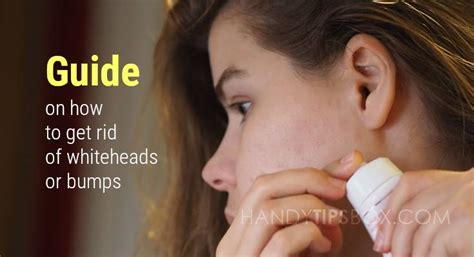 They appear like small skin coloured bumps that form on your forehead or jawline. Guide on how to get rid of whiteheads or bumps - La Caja ...