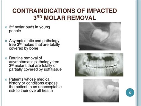 Presurgical Assessment Of Impacted Molar Tooth