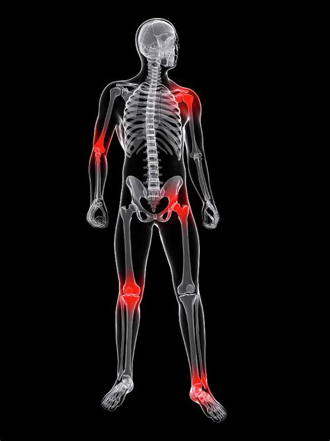 Joint Pain Photograph By Scieproscience Photo Library
