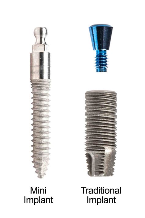 What Is A Mini Dental Implant Dental News Network