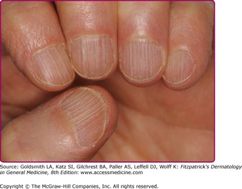 Biology Of Nails And Nail Disorders Plastic Surgery Key