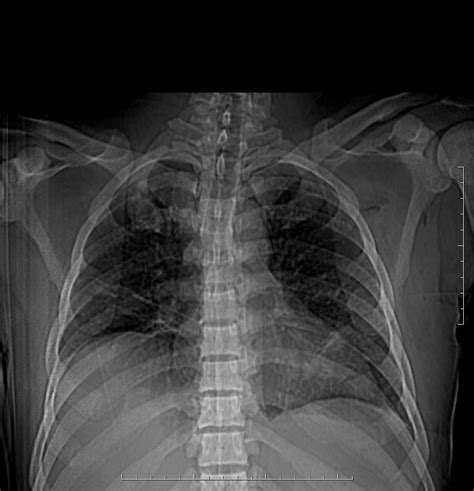 Pulmonary Cryptococcosis Image