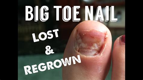 Big Toe Nail Loss And Re Growth Over 8 Months Youtube
