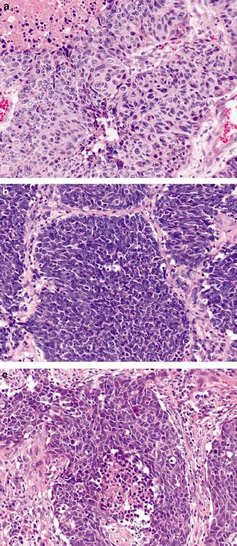 A Large Cell Neuroendocrine Carcinoma This Tumor Has Organoid