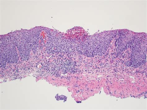Pathology Outlines Eosinophilic Esophagitis