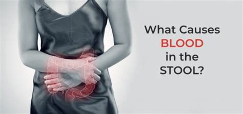 What Does Blood In Stool Look Like Home Remedies For Rectal Bleeding