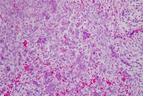Cherubism has historically been considered a variant of fibrous dysplasia, but in reality is likely a distinct entity. Oral Pathology Seattle - Oral Pathology Biopsy Service -UW School of Dentistry