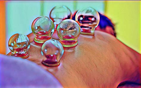 Cupping Therapy Gone Wrong Understanding Risks And Ensuring Safe Practice Cupping Therapy Guide