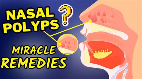Best Natural Remedies For Nasal Polyps How To Treat Nasal Polyps At