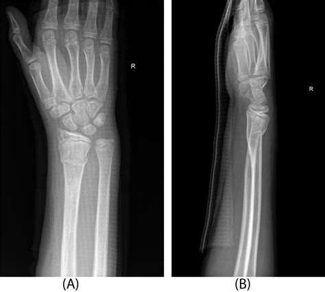 Premature Physeal Closure Of An Extraphyseal Distal Radius Fracture My XXX Hot Girl