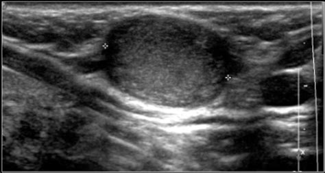 Sebaceous Cyst Vs Lipoma Ultrasound