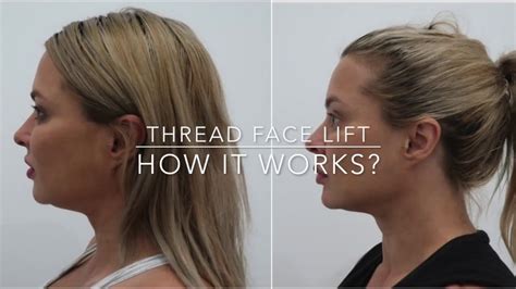 How Non Surgical Facelifts Work Youtube