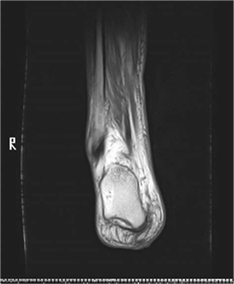 Eccrine Porocarcinomas The Foot And Ankle Online Journal