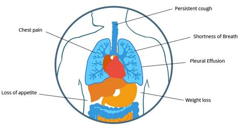 The type of treatment you receive depends on where the cancer is found. Peritoneal Mesothelioma Signs and Symptoms - CancerOz