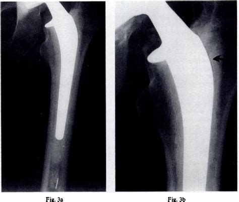 Figure 2 From Improved Cementing Techniques And Femoral Component