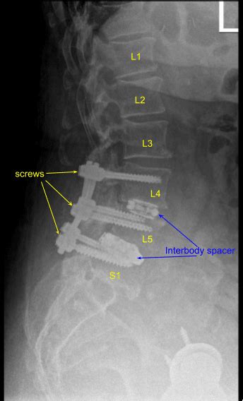 Case Study L3 S1 Laminectomy And Fusion Complete Orthopedics